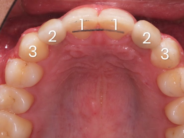 Implant uchun joy ochish, yuqori tish qatori: hozir